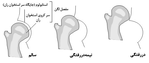 روش های درمان بیماری دررفتگی مادرزادی لگن