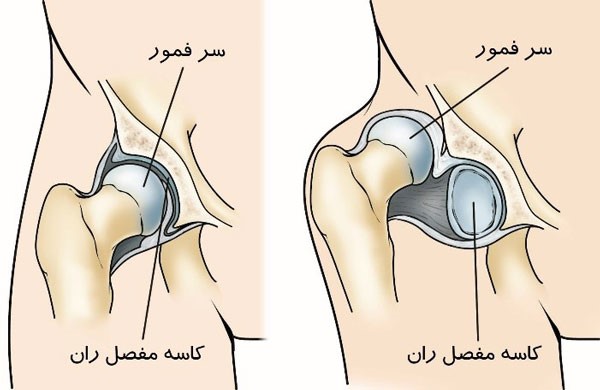 در رفتگی مادر زادی لگن چیست؟