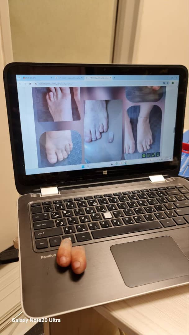 بیماری براکی متاتارس