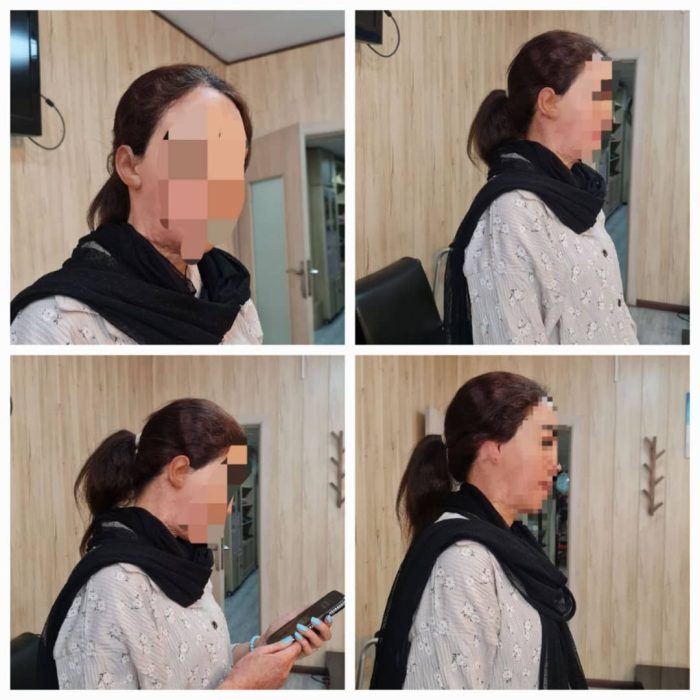 پروتز گوش