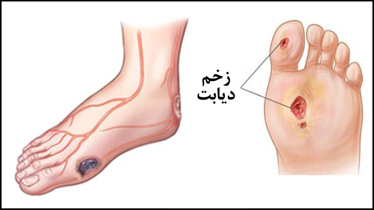 چه زمانی پای دیابتی قطع می‌شود؟