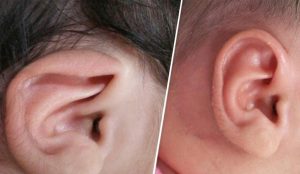 بدشکلی های موجود در گوش خارجی