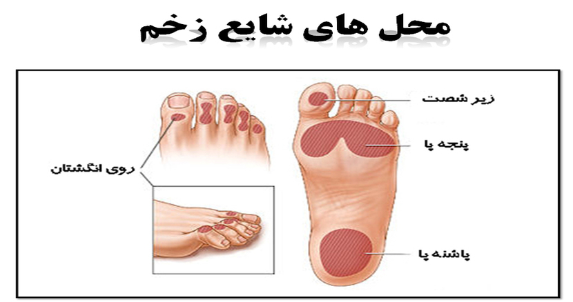 پای دیابتیک