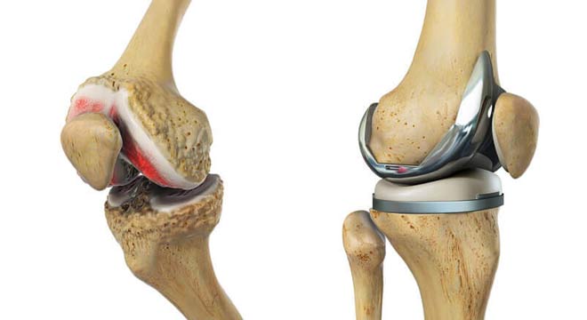 پیشگیری از نیاز به تعویض مفصل زانو
