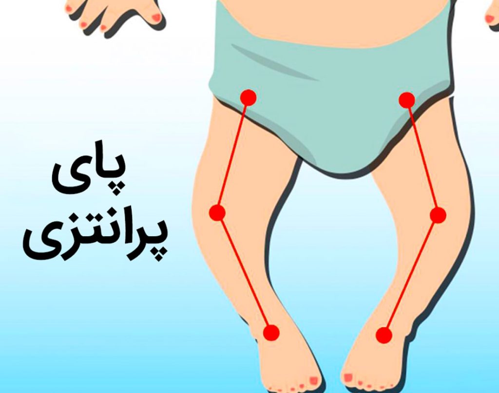 درمان پای پرانتزی با کفش طبی