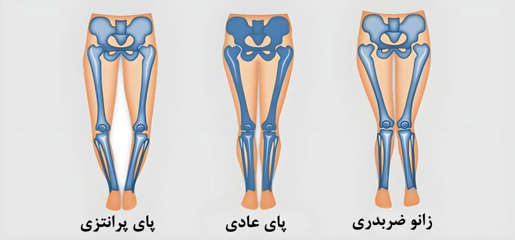   تاثیر فیزیوتراپی در روند درمان پای پرانتزی