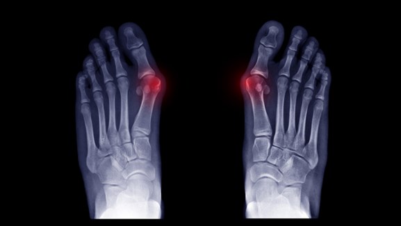 انواع hallux valgus