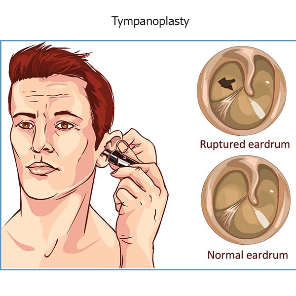 انواع تمپانوپلاستی