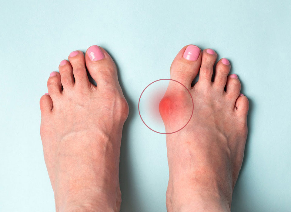 علائم hallux valgus