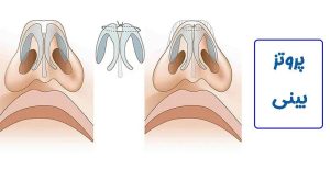 استفاده از پروتز در جراحی بینی