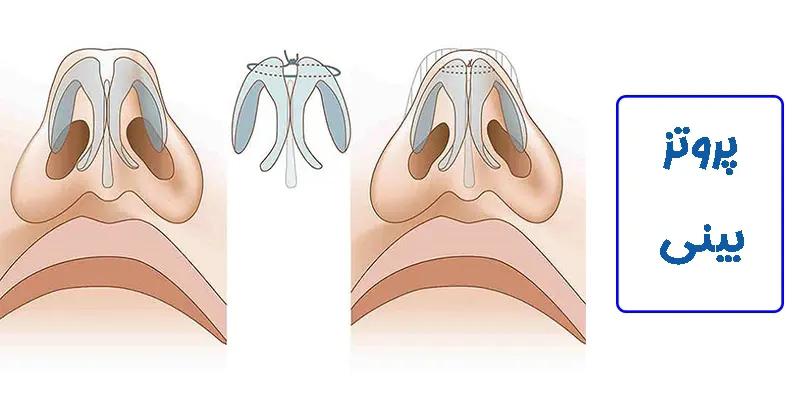 استفاده از پروتز در جراحی بینی