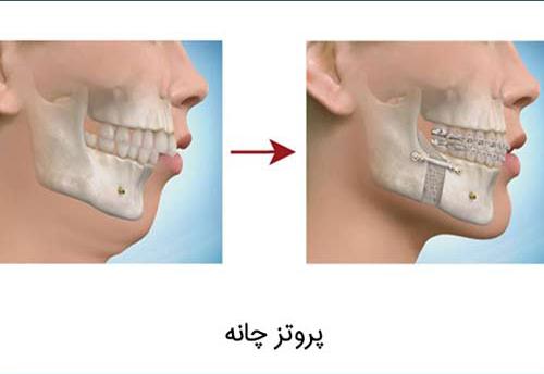 نحوه ی جراحی پروتز چانه