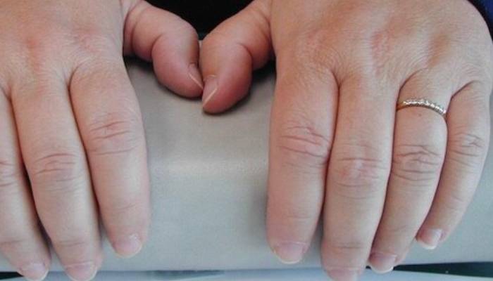 تأثیر پروتز انگشت بر بازگشت زیبایی و اعتماد به نفس