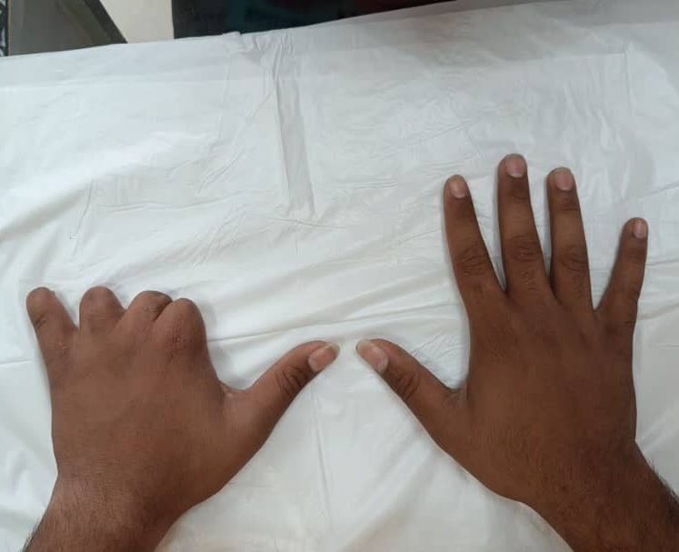 پروتز انگشت