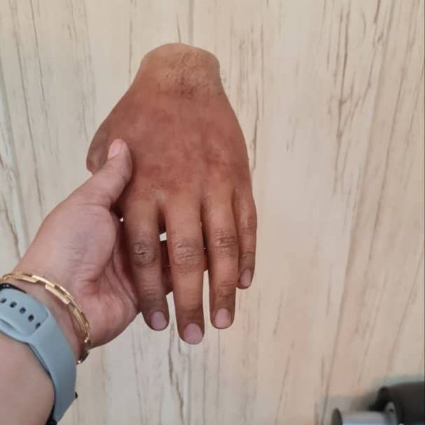 پروتز دست