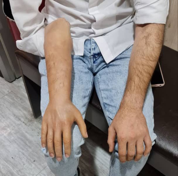 پروتز دست