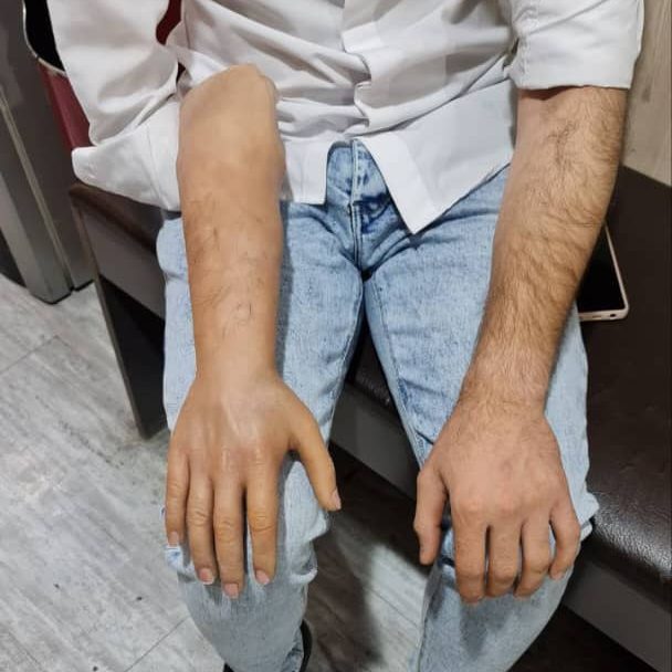 پروتز دست