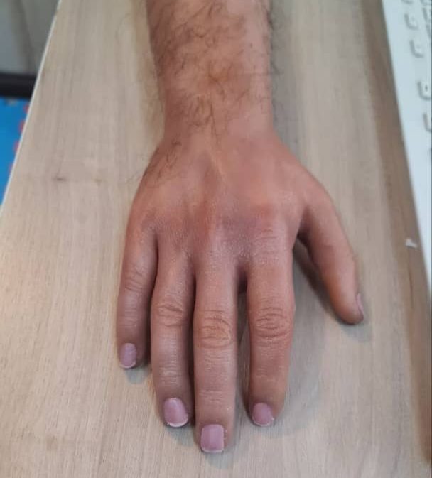 پروتز دست