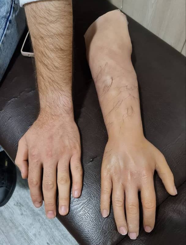 پروتز دست