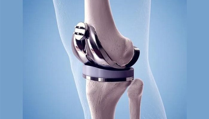 نحوه افزایش عمر پروتز زانو