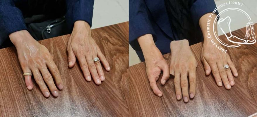 نحوه مراقبت و نگهداری از پروتز دست