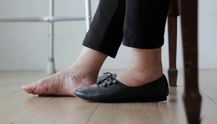پروتز پای دیابتی