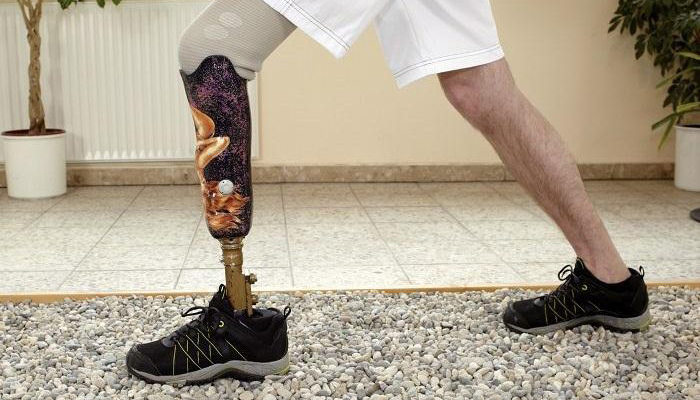 پروتز پای هوشمند