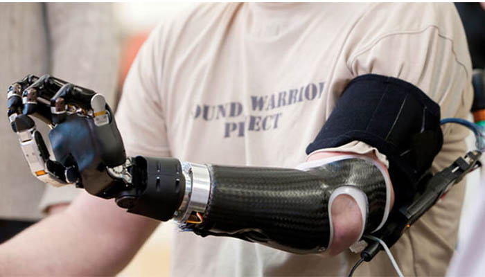 پروتز بالای آرنج دست