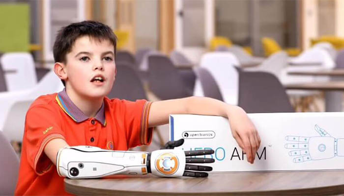 پروتز بالای آرنج دست