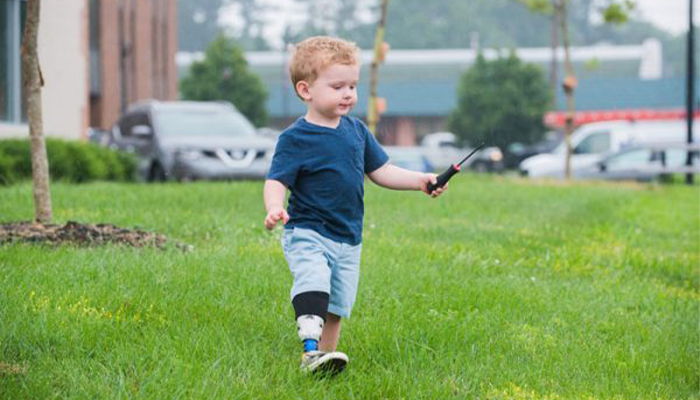 پروتز پا برای کودکان