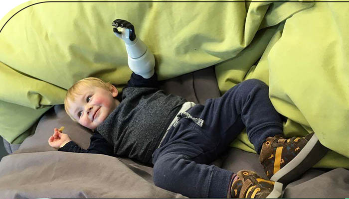 پروتز دست برای کودکان