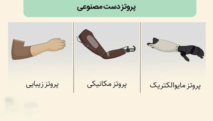 راهنمای کامل انتخاب پروتز دست مصنوعی