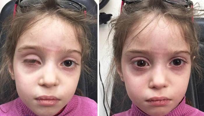 مقایسه انواع پروتز چشم