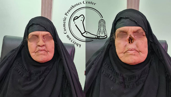 پروتز بینی