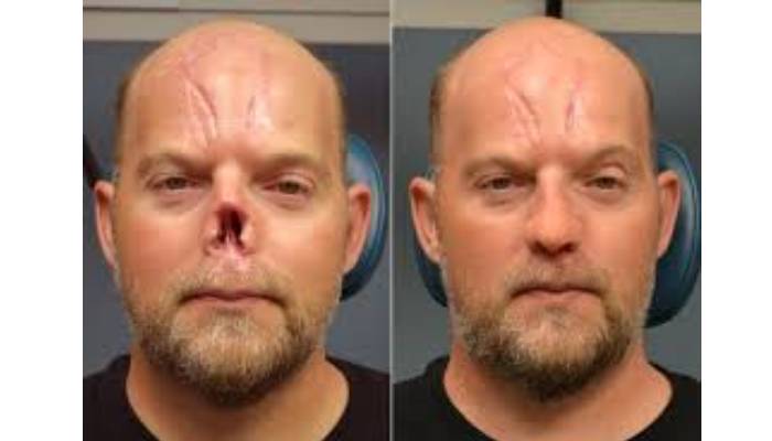 کاربرد پروتز بینی