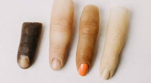 پروتز انگشت قطع شده دست