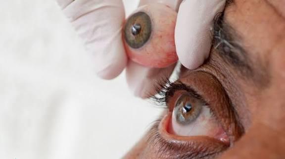 پروتز چشم یا چشم مصنوعی چیست؟