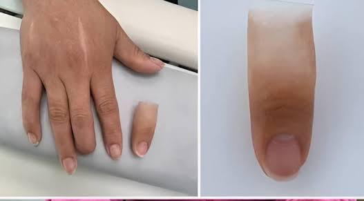 عوامل تعیین کننده قیمت پروتز انگشت قطع شده دست