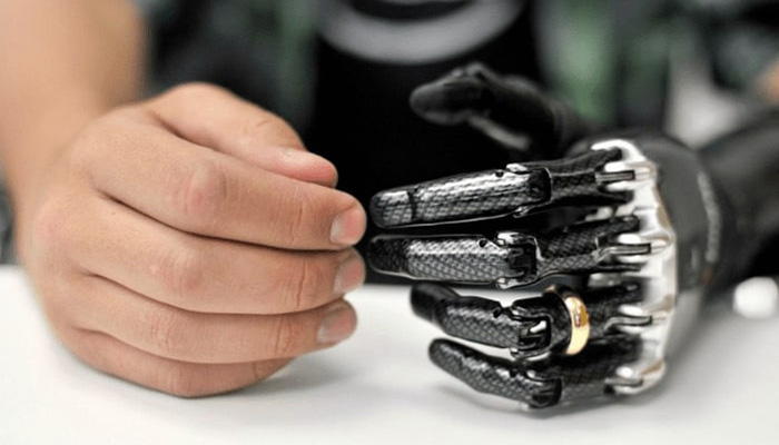 پروتز اندام فوقانی