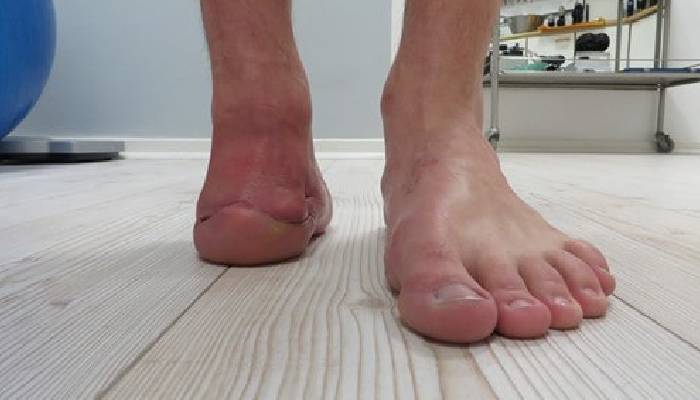 پروتز پنجه پا