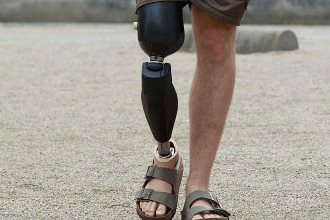 انواع پروتز بالای زانو