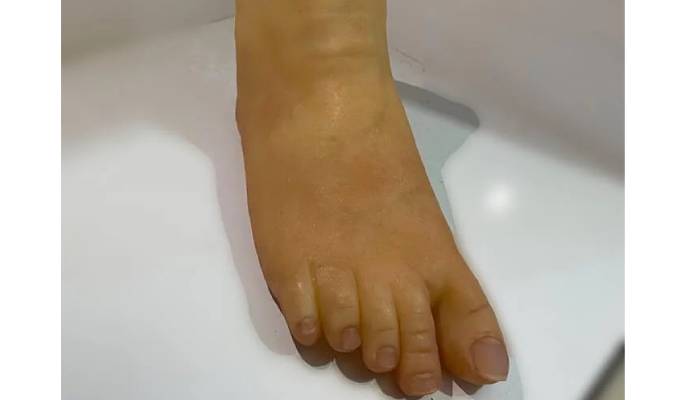 انواع پروتز بالای زانو