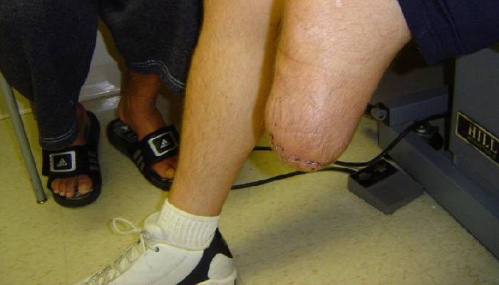 مسیر سازگاری بدن با پروتز بعد از قطع عضو