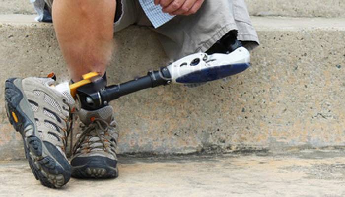 روند بازگشت توان حرکتی پس از قطع عضو