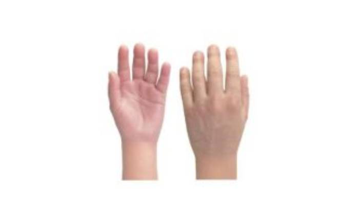 پروتز دست سیلیکونی 