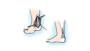 اسپلینت کوتاهی آشیل