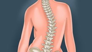 علت اسکولیوز چیست؟